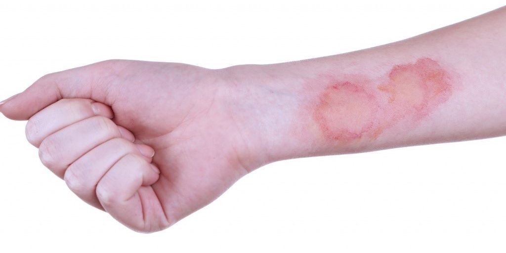 Что убирает ожог от газа