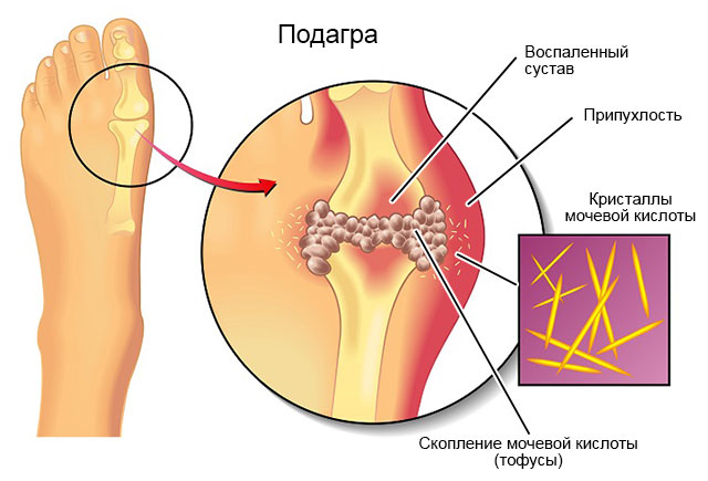 подагра