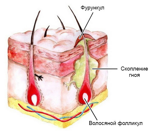 фурункулез