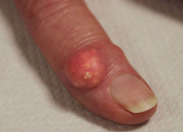 подагрический тофус