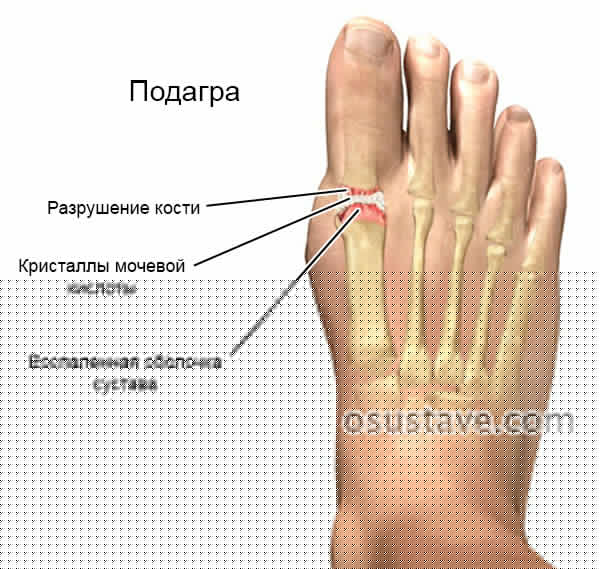 подагра
