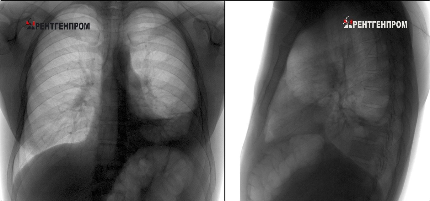 Осумкованный экссудативный плеврит