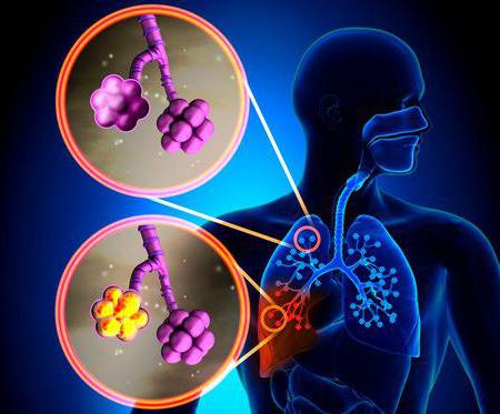 пневмония без симптомов