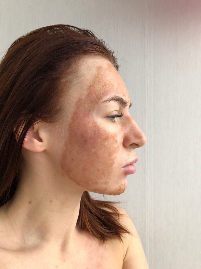 Лазерная шлифовка ожога 3 степени