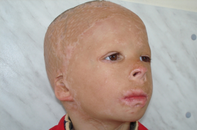 Краснодарский край ожог у мальчика