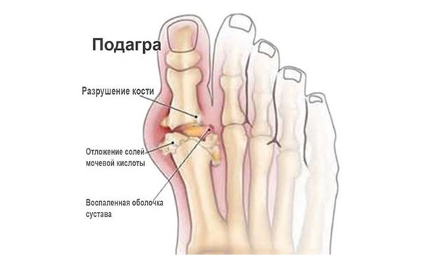 Массажи для ног от подагры