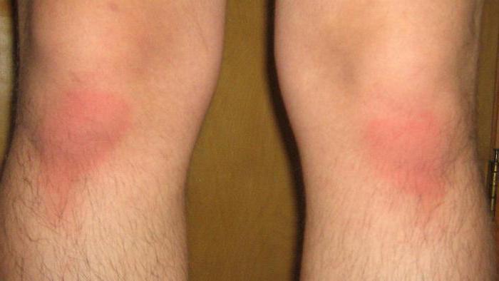 ковровый ожог