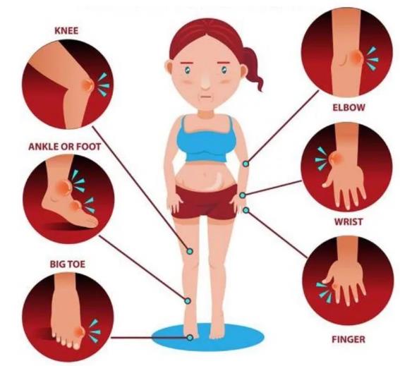 Что такое подагра локтей и как ее лечить