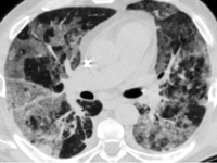 Интерстициальная пневмония Интерстициальная пневмония