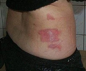 след на коже от ожога