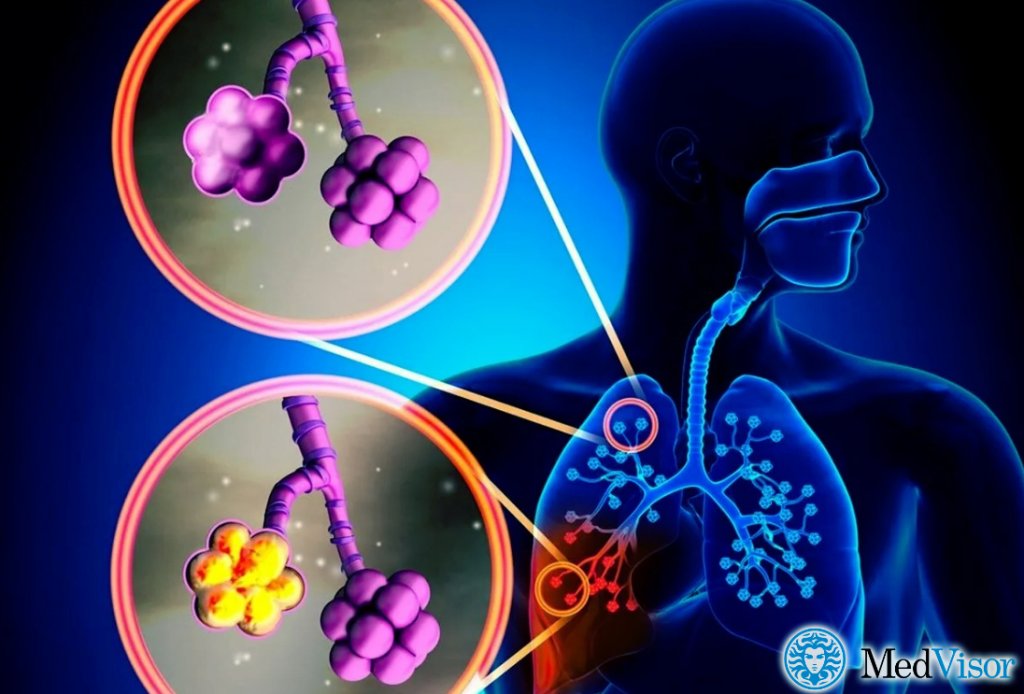Пневмония без уточнения возбудителя Можно ли бронхит перепутать с пневмонией на рентгене