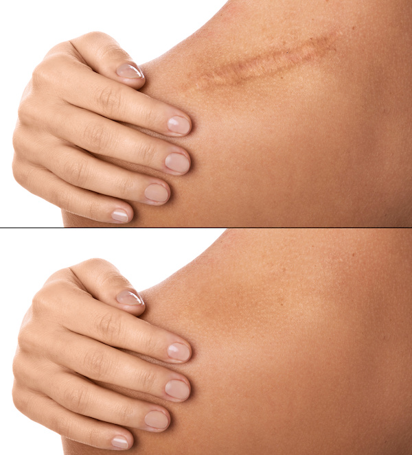 лечение лазером