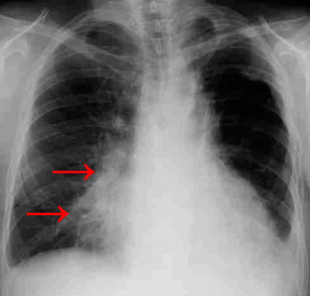 снимок пневмонии у взрослого