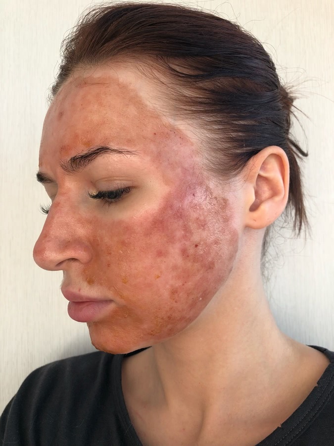 Лазерная шлифовка ожога 3 степени