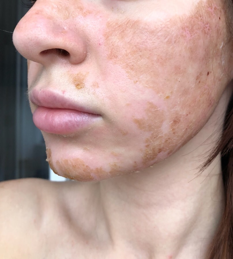 Лазерная шлифовка ожога 3 степени