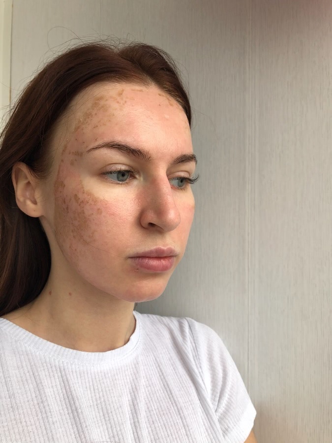 Лазерная шлифовка ожога 3 степени