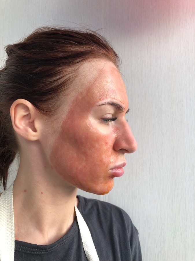 Лазерная шлифовка ожога 3 степени