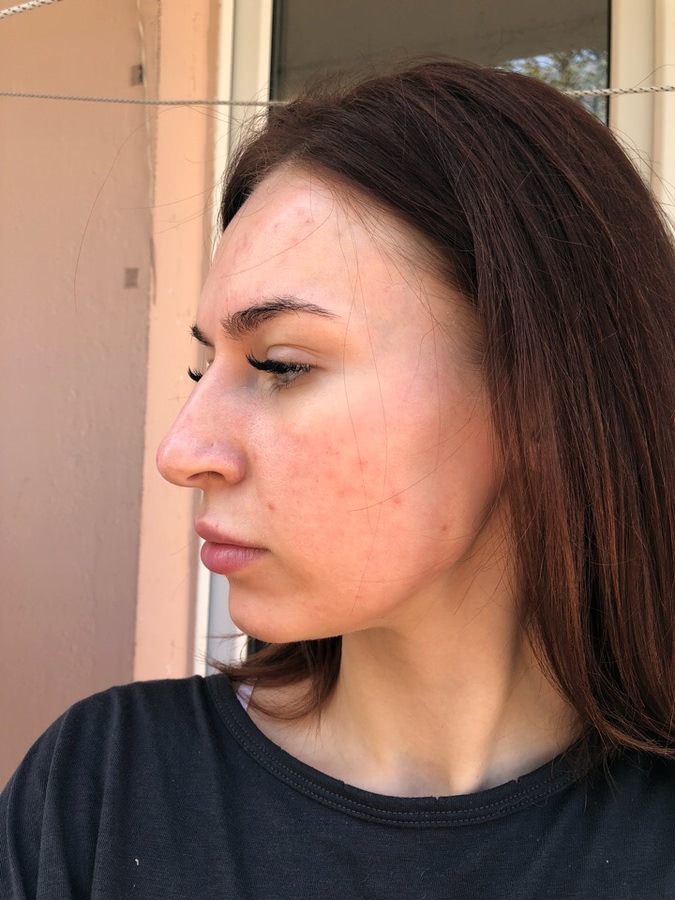 Лазерная шлифовка ожога 3 степени