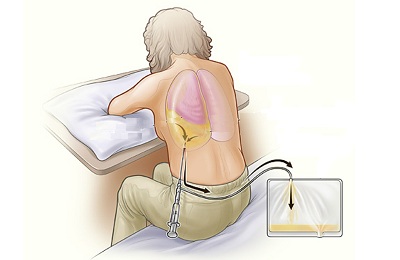 Выкачка жидкости