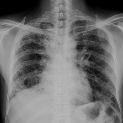 Начальная фаза интерстициальной пневмонии проявляется