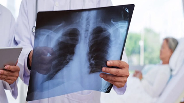 Начальная фаза интерстициальной пневмонии проявляется