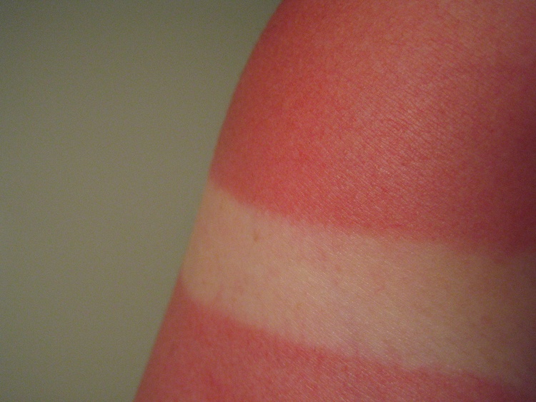 Жирный крем при солнечном ожоге Жирный крем при солнечном ожоге thumbnail