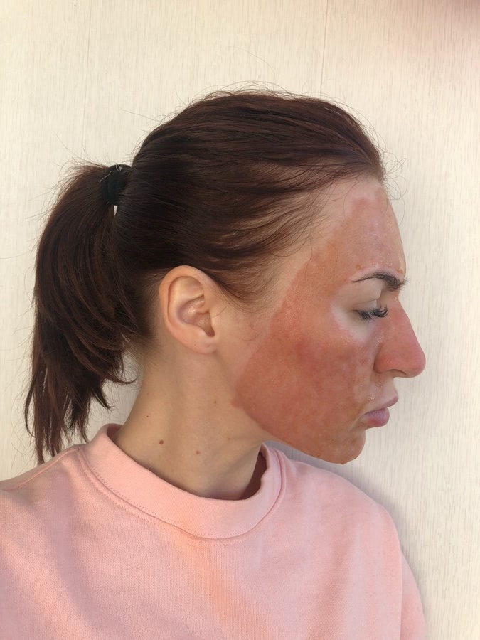 Лазерная шлифовка лица. Как это было: дневник реабилитации+ фото