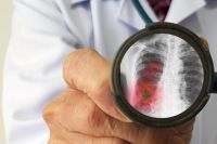 Как часто люди болеют пневмонией