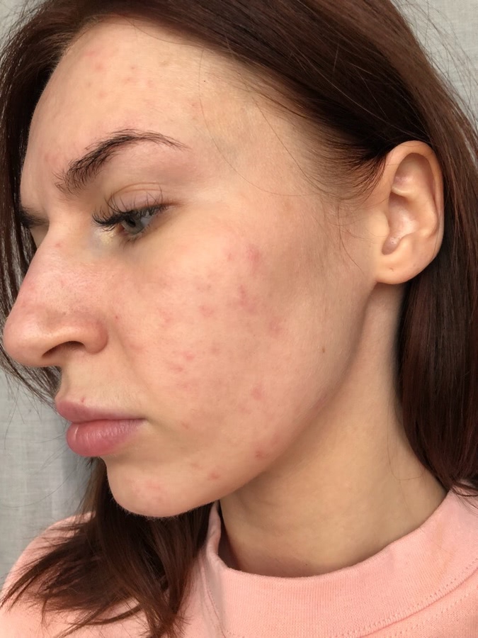 Лазерная шлифовка лица. Как это было: дневник реабилитации+ фото