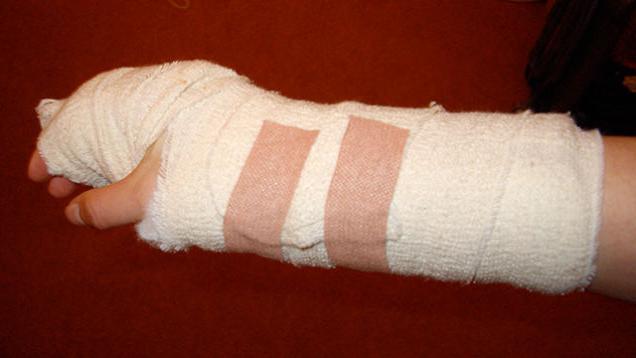 чем обработать ожог кипятком