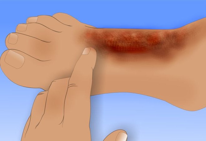 чем обрабатывать ожог