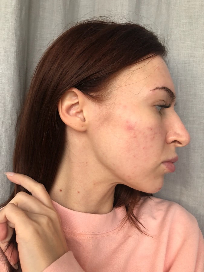 Лазерная шлифовка лица. Как это было: дневник реабилитации+ фото