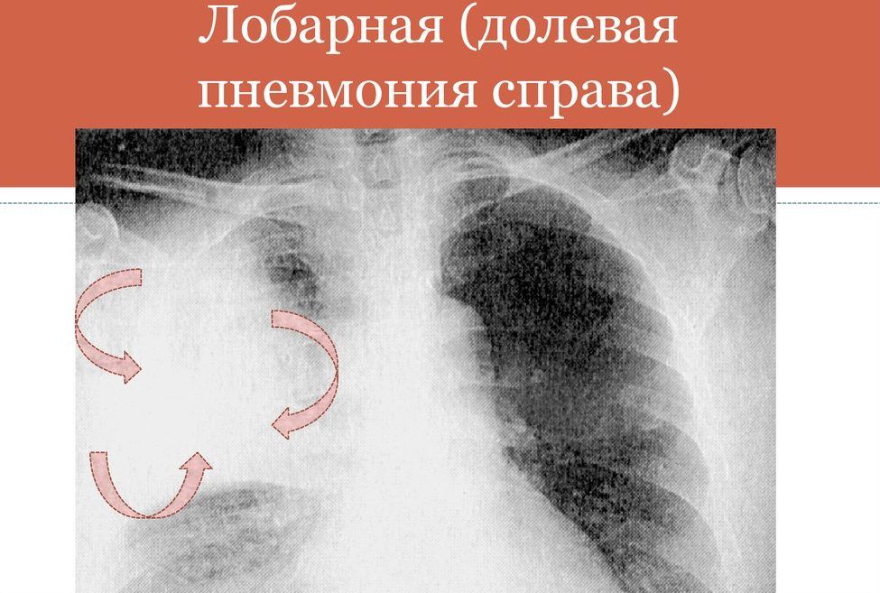 Лобарная казеозная пневмония