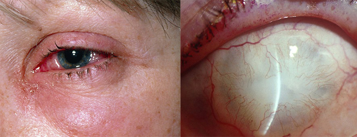 Ожог глаза щелочью: первая помощь Ожог глаза щелочью: первая помощь