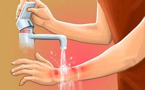 Чем облегчить боль от ожога утюгом