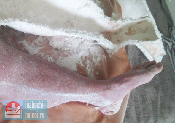 Пациенты, получившие множественные травмы (например, перелом позвоночника и костей конечностей), которым был наложен гипс, при неблагоприятных обстоятельствах могут быть подвержены образованию некрозов как на открытых участках тела, так и под гипсовыми повязками. Образование пролежня от гипсовой повязки