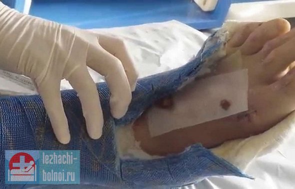 по статистике, пролежни появляются у 80% всех пациентов с открытыми переломами, вследствие неизбежного при этом виде травмы повреждения сосудов и нервных стволов. Что делать, если под гипсом образовались пролежни