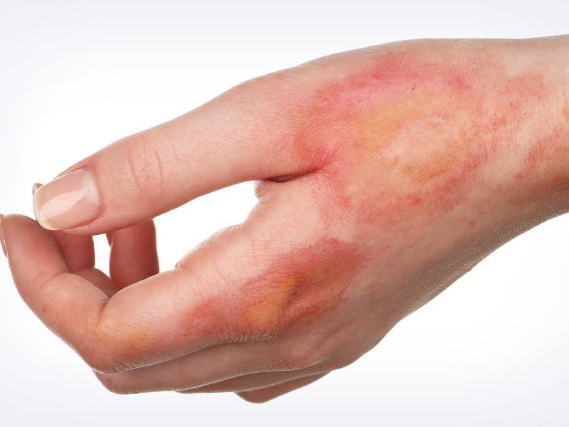 степень ожога