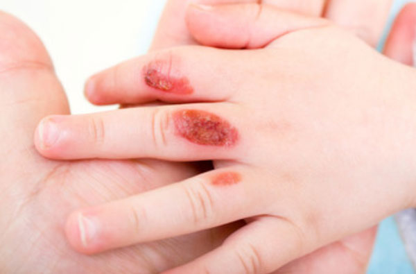 Ручка ребенка с ожогами