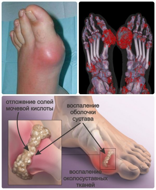 Подагра ног и жжение стопы