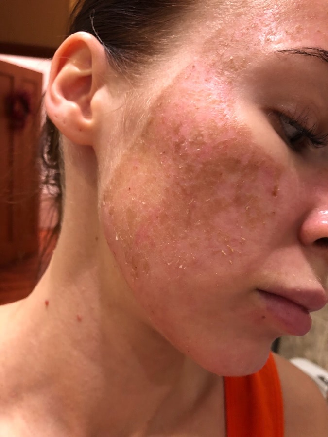 Лазерная шлифовка ожога 3 степени