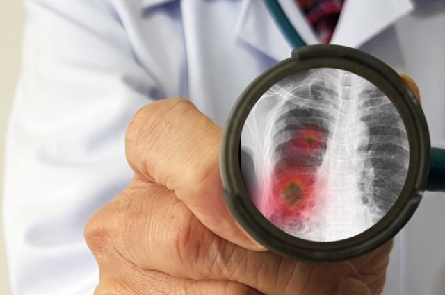 Больному пневмонией врач назначил препарат после 2 дней применения