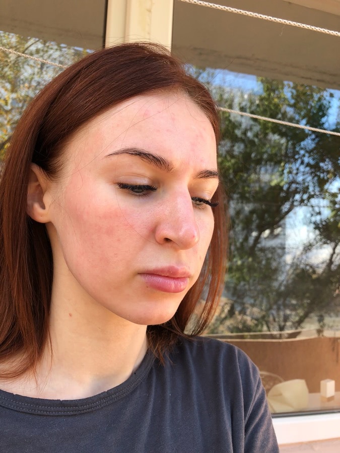 Лазерная шлифовка ожога 3 степени