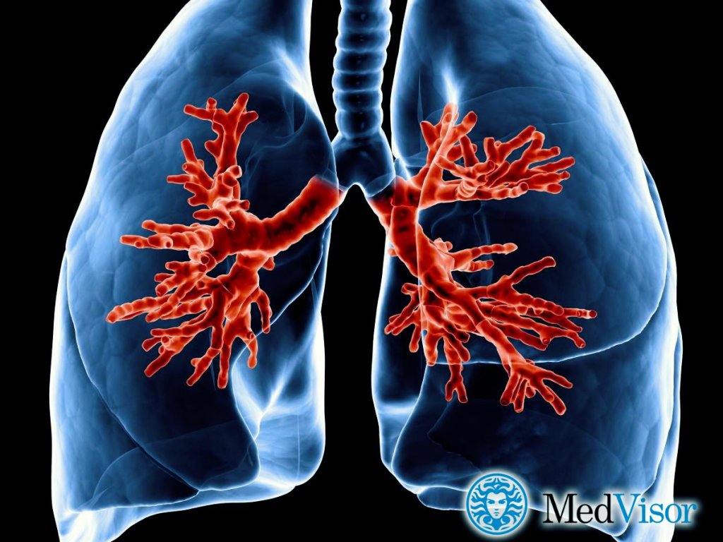 Острый бронхит что это Можно ли бронхит перепутать с пневмонией на рентгене