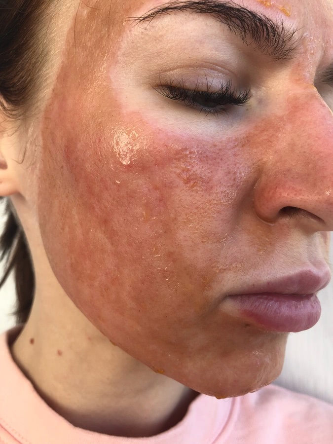 Лазерная шлифовка ожога 3 степени