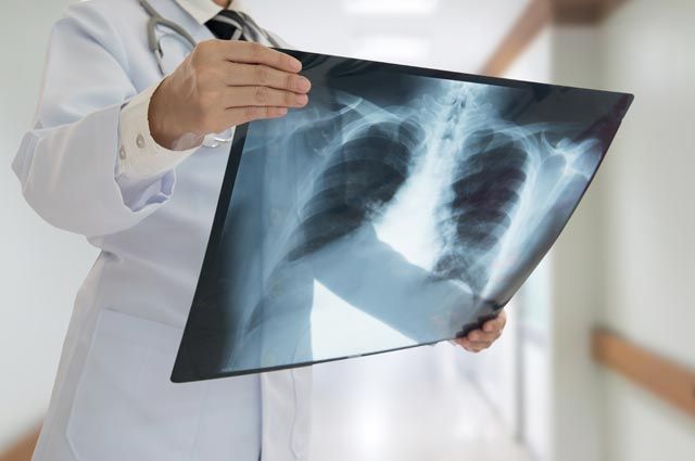 Больному пневмонией врач назначил препарат после 2 дней применения