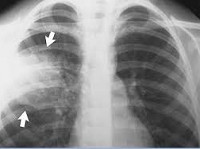 Пневмококковая пневмония Пневмококковая пневмония