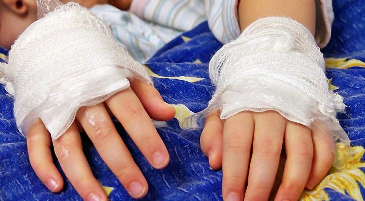 Что запрещено при ожоге?