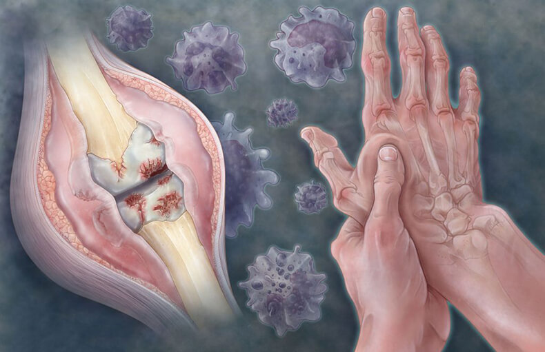 Почему «горят» пятки: Психосоматика подагры и жжения в ступнях Почему «горят» пятки: Психосоматика подагры и жжения в ступнях