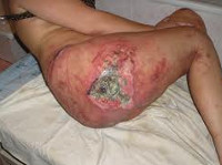 От чего у человека пролежни От чего у человека пролежни thumbnail